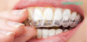 بلیچینگ دندان و معایب و مزایای آن